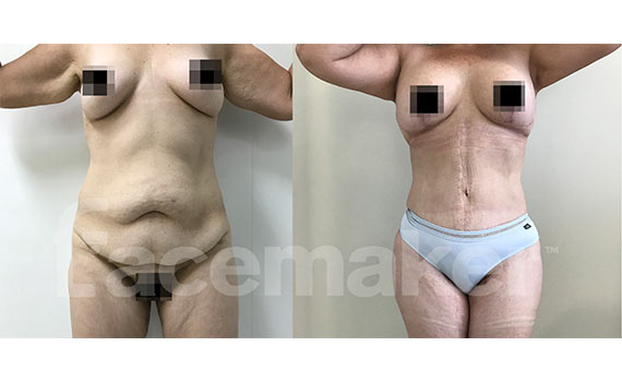 abdominoplasty