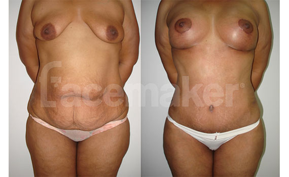 before and after abdominoplasty