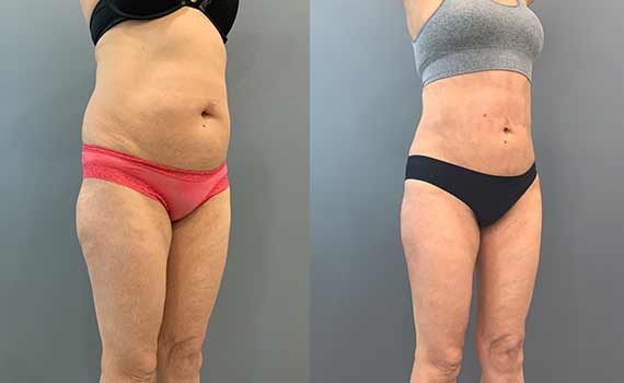 liposuction