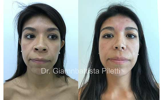 rhinoplastia