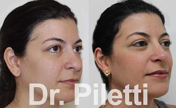 before and after rhinoplasty