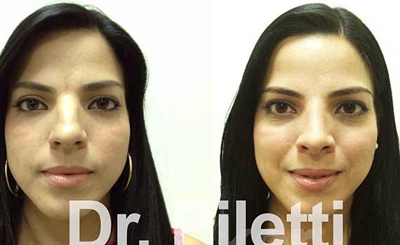 before and after rhinoplasty